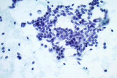 Smear-Pap-Stain-40x-Patients-Previous-MTC