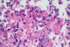 Traditional cell block H&E 40x