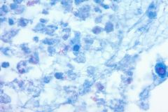 nocardia-cellient-fite-oil-immersion-1000x