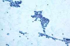 ClustersOfTumor_20x_200mag_ThinPrep