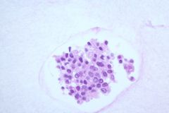 TumorClusterCB_40x_400mag_CellBlock