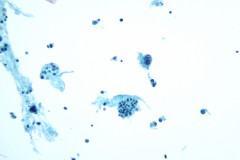 TumorComparisonToNormal2_20x_200mag